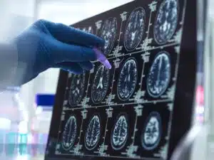 scientist analyzing alzheimer's and dementia brain